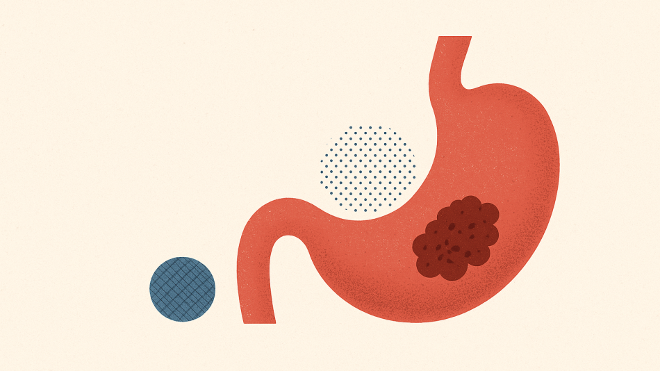 Mide Kanseri: Erken Tanı ve Korunma Yolları